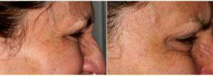 62 Year Old Woman Treated With Botox Crows Feet With Dr. Yasaman S. Roland, DDS, Annapolis Dentist Loading