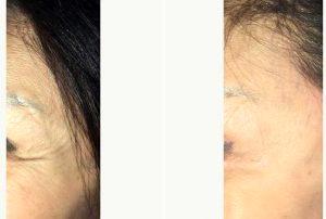 63 Year Old Woman Treated With Botox With Dr. Amir Kachooei, DDS, London Dentist