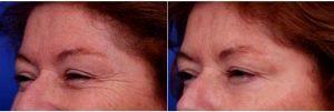 63 Year Old Woman Treated With BotoxTreatment Areas Include Glabella, Crows Feet By Doctor Thomas J. Walker, MD, Atlanta Facial Plastic Surgeon