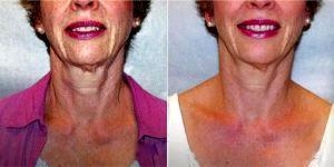 64 Year Old Female Treated With Botox To Tighten Neck And Jowls With Dr. Cheryl Perlis, MD, FACOG, Highland Park Physician