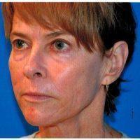 64 Year Old Woman Treated With Botox By Doctor E. John Serrao, MD, Orlando OB-GYN