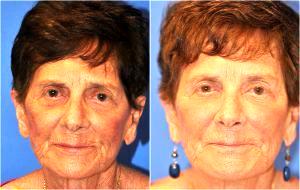 78 Year Old Female Who Underwent Injection Of 4 Syringes Of Radiesse For A Full Liquid Facelift By Dr. Avron Lipschitz, MD, Palm Beach Gardens, FL Plastic Surgeon