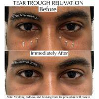 A Great Non-surgical Option Soften The Appearance Of Under Eye Bags