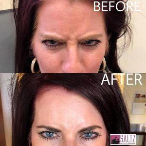 After 10 Days Of Botox On Frown Lines ByDR. RENATO SALTZ,Salt Lake City