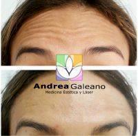 An Effective Treatment For Folds And Creases Around Your Forehead