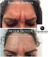 BOTOX Cosmetic Will Relax The Muscular Contractions Causing The Groove In Your Skin