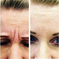 BOTOX Reduces Targeted Lines And Wrinkles