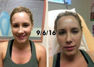 Beautiful Results With Dysport & Restylane Silk At Dr. Merey's Medical Bariatric & Rejuvenation Center In West Palm Beach