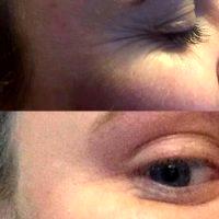 Before And After Botox For Crow's Feet Wrinkles