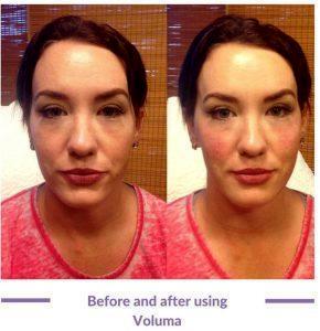 Before And After Injection Of Dermal Filler Under The Eyes And Cheeks By