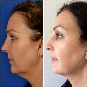 Before And After Kybella Under Chin By Los Angeles Cosmetic Surgeon Dr. Alexander Rivkin