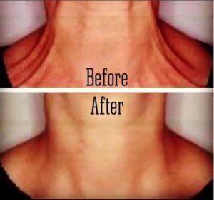 Before And After Photos Of Botox For Platysmal Bands, And Neck Lines