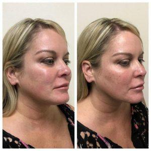 Before And After Voluma Cheek Augmentation At Avalon Laser, Skin Care Clinic In San Diego, California