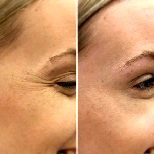 Benefits Of Botox For Crows Feet (3)