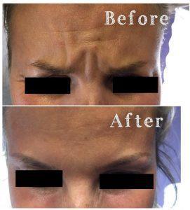 Benefits Of Botox For Frown Lines (1)