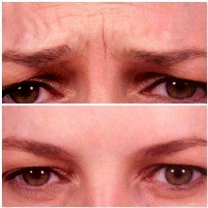 Benefits Of Botox For Frown Lines (2)