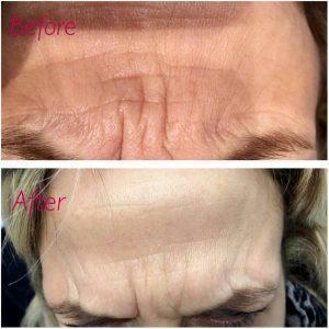 Benefits Of Botox For Wrinkles Photos (1)