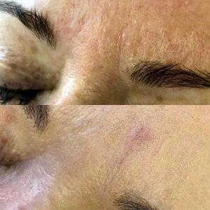 Benefits Of Botox For Wrinkles Photos (2)