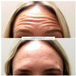 Benefits Of Botox In Forehead Before And After (2)