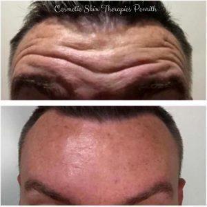 Benefits Of Botox In Forehead Before And After (3)