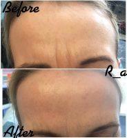 Best Frown Lines Treatment Botox