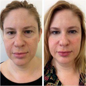 Blepharoplasty (Under Eyes) With Juvederm, And Cheeks And Nasal Labial Folds Using Voluma By Los Angeles Cosmetic Surgeon Dr. Alexander Rivkin