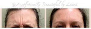 Botox 11 Before And After Photos (1)