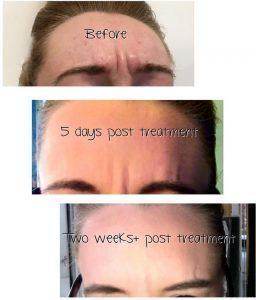 Botox 11 Lines Before & After, 5 Days And 2 Weeks Post Treatment