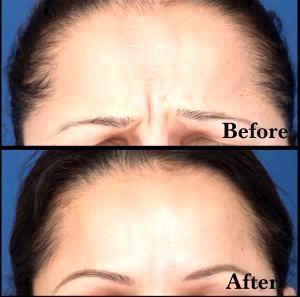Botox 11s Before And After Photos (1)