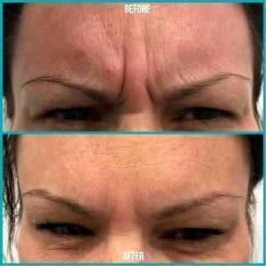 Botox 11s Before And After Photos (2)