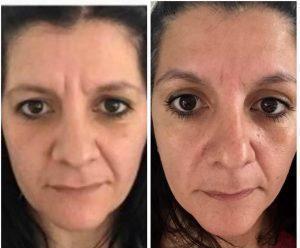 Botox And 11 Lines Before And After