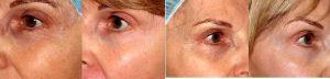 Botox And After Before With Dr. Richard Fitzpatrick, MD , San Diego Dermatologic Surgeon