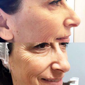 Botox And Filler Injections At Beverly Hills Rejuvenation Center
