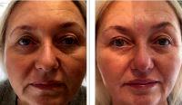Botox And Its Competitors Will Improve Active Wrinkles