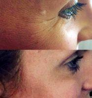 Botox Around Eyes Before And After Photos (1)