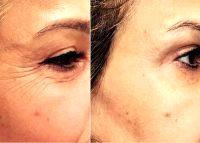 Botox Around Eyes Before And After Photos (11)