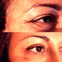 Botox Around Eyes Before And After Photos (12)