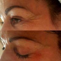 Botox Around Eyes Before And After Photos (2)
