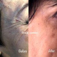 Botox Around Eyes Before And After Photos (4)