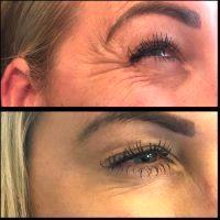 Botox Around Eyes Before And After Photos (5)