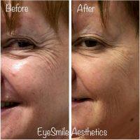 Botox Around Eyes Before And After Photos (7)