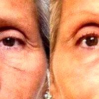 Botox Around Eyes Before And After Photos (9)