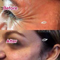 Botox Around Eyes Before And After Pictures (1)