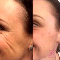 Botox Around Eyes Before And After Pictures (11)