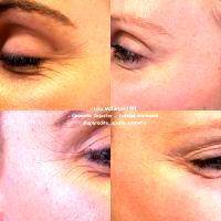 Botox Around Eyes Before And After Pictures (12)