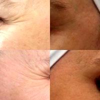 Botox Around Eyes Before And After Pictures (3)