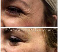 Botox Around Eyes Before And After Pictures (4)