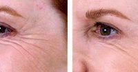 Botox Around Eyes Before And After Pictures (5)