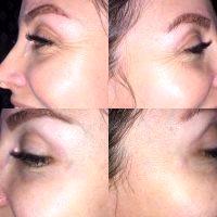 Botox Around Eyes Before And After Pictures (6)