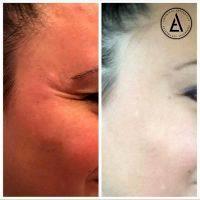 Botox Around Eyes Before And After Pictures (9)